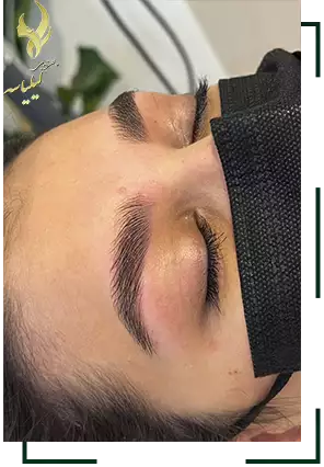 عکس لیفت ابرو قبل و بعد